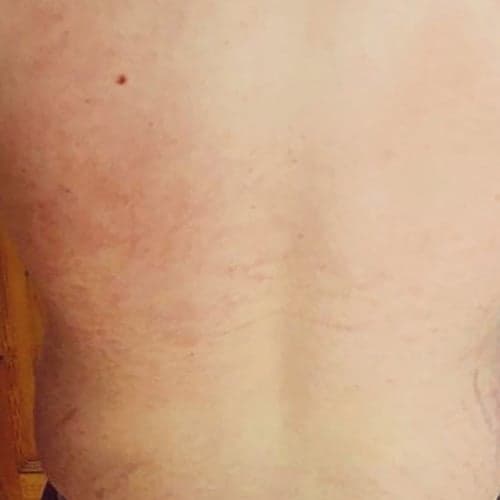 tri-wave-skin-after